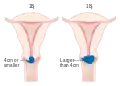 Stage 1B cervical cancer