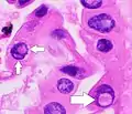 Nuclear pseudoinclusions, which are invaginations of cytoplasm into the nucleus.