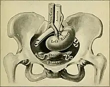 An labelled illustration showing an ectopic kidney inside an anatomically female human abdomen
